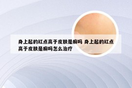 身上起的红点高于皮肤是癣吗 身上起的红点高于皮肤是癣吗怎么治疗