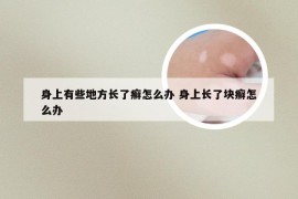 身上有些地方长了癣怎么办 身上长了块癣怎么办