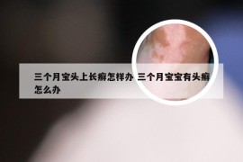 三个月宝头上长癣怎样办 三个月宝宝有头癣怎么办