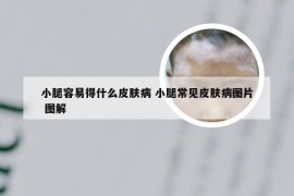 小腿容易得什么皮肤病 小腿常见皮肤病图片 图解