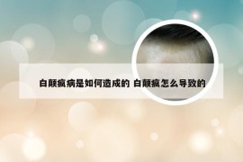 白颠疯病是如何造成的 白颠疯怎么导致的