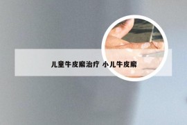 儿童牛皮廨治疗 小儿牛皮廨