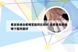 看皮肤病合肥哪家医院比较好 合肥看皮肤病哪个医院最好