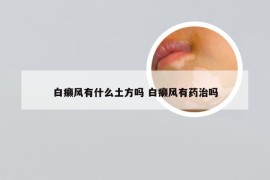 白癞风有什么土方吗 白癞风有药治吗