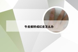 牛皮癣转成红皮怎么办