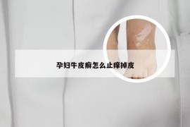 孕妇牛皮癣怎么止痒掉皮