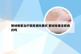 聊城哪里治疗银屑病效果好 聊城有看皮肤病的吗
