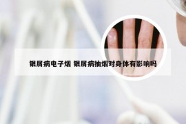 银屑病电子烟 银屑病抽烟对身体有影响吗