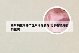 银屑病北京哪个医院治得最好 北京看银屑病的医院