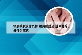 银屑病脱皮什么样 银屑病脱皮,越来越痒,是什么症状