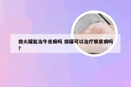 拔火罐能治牛皮癣吗 拔罐可以治疗银屑病吗?