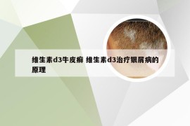 维生素d3牛皮癣 维生素d3治疗银屑病的原理