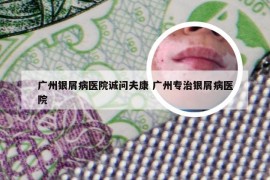 广州银屑病医院诚问夫康 广州专治银屑病医院
