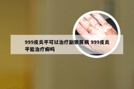 999皮炎平可以治疗副银屑病 999皮炎平能治疗癣吗