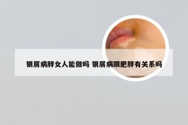 银屑病胖女人能做吗 银屑病跟肥胖有关系吗