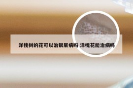 洋槐树的花可以治银屑病吗 洋槐花能治病吗