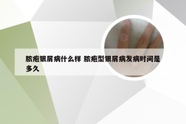 脓疱银屑病什么样 脓疱型银屑病发病时间是多久