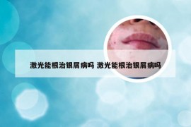 激光能根治银屑病吗 激光能根治银屑病吗