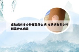 皮肤病有多少种都是什么病 皮肤病有多少种都是什么病毒