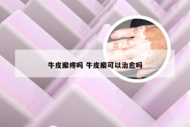 牛皮廨疼吗 牛皮廨可以治愈吗