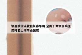 银屑病传染就信长春华山 全国十大银屑病医院排名上海华山医院