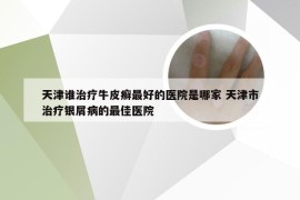 天津谁治疗牛皮癣最好的医院是哪家 天津市治疗银屑病的最佳医院