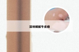 深圳缓解牛皮癣
