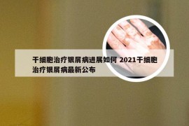 干细胞治疗银屑病进展如何 2021干细胞治疗银屑病最新公布