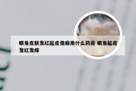 眼角皮肤发红起皮像癣用什么药膏 眼角起皮发红发痒