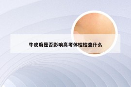 牛皮癣是否影响高考体检检查什么