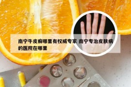 南宁牛皮癣哪里有权威专家 南宁专治皮肤病的医院在哪里