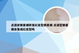 点滴状银屑病转变红皮型银屑病 点滴型银屑病会变成红皮型吗