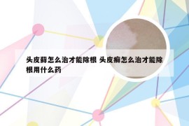 头皮藓怎么治才能除根 头皮癣怎么治才能除根用什么药