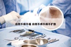 白斑不痒不痛 白斑不疼不痒不扩散