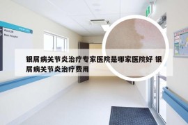 银屑病关节炎治疗专家医院是哪家医院好 银屑病关节炎治疗费用