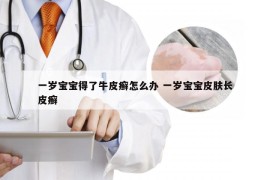 一岁宝宝得了牛皮癣怎么办 一岁宝宝皮肤长皮癣