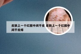 皮肤上一个红圈中间干皮 皮肤上一个红圈中间干皮痒