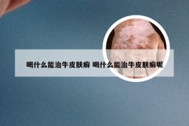 喝什么能治牛皮肤癣 喝什么能治牛皮肤癣呢