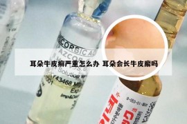 耳朵牛皮癣严重怎么办 耳朵会长牛皮廨吗