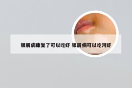 银屑病康复了可以吃虾 银屑病可以吃河虾