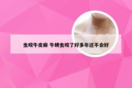 虫咬牛皮癣 牛蜱虫咬了好多年还不会好