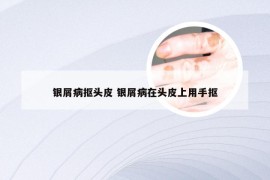 银屑病抠头皮 银屑病在头皮上用手抠