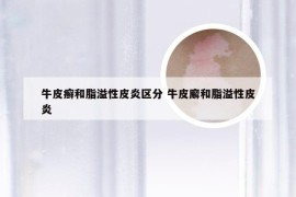 牛皮癣和脂溢性皮炎区分 牛皮廨和脂溢性皮炎