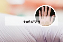 牛皮癣能芋艿吗