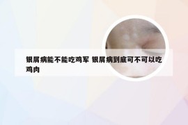 银屑病能不能吃鸡军 银屑病到底可不可以吃鸡肉