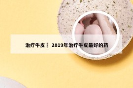 治疗牛皮廯 2019年治疗牛皮最好的药