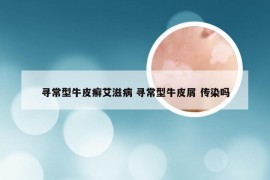 寻常型牛皮癣艾滋病 寻常型牛皮屑 传染吗