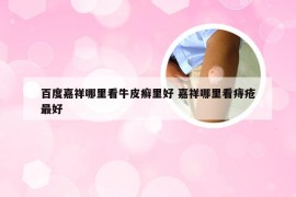 百度嘉祥哪里看牛皮癣里好 嘉祥哪里看痔疮最好