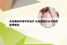 头皮癣的外用中药治疗 头皮癣用什么中草药能够根治