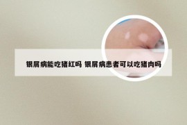 银屑病能吃猪红吗 银屑病患者可以吃猪肉吗